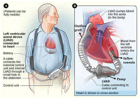 lv assist devices|left ventricular assist devices lvads.